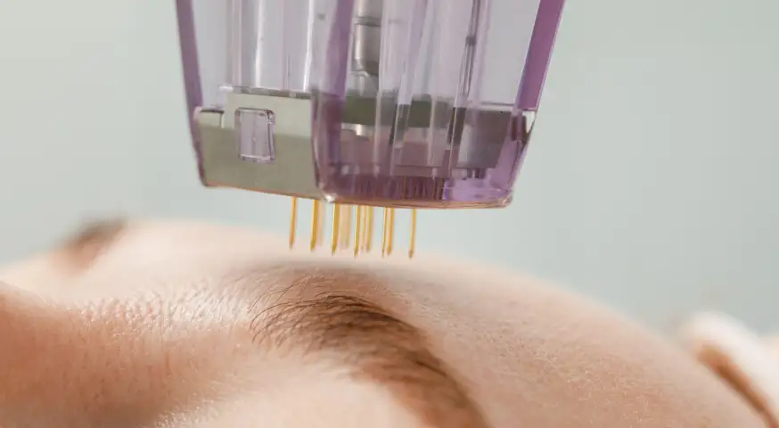 Morpheus8 microneedling device close-up.