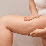 Before cellulite treatment with Sculptra and Morpheus8 in White Rock BC