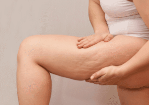 Before cellulite treatment with Sculptra and Morpheus8 in White Rock BC