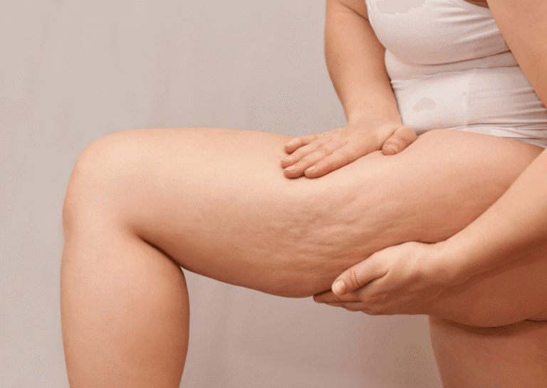Before cellulite treatment with Sculptra and Morpheus8 in White Rock BC