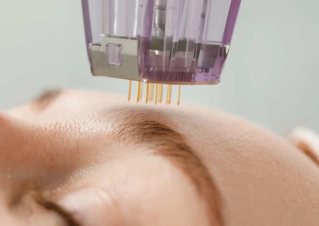 Advanced aesthetic treatment using Morpheus8 RF microneedling and IPL to support skin texture, pigmentation, and collagen strength.