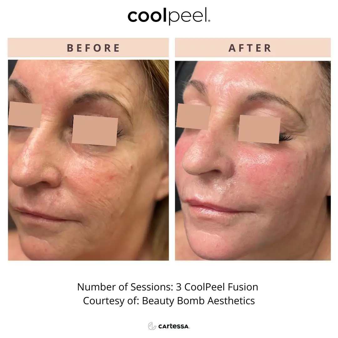 Helix_DrBelindaCaperaCoolPeelFusionBeautyBomb173437797048