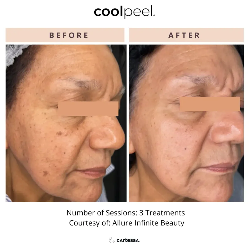 Patient noticing early sun damage and uneven skin tone before considering CoolPeel laser treatment