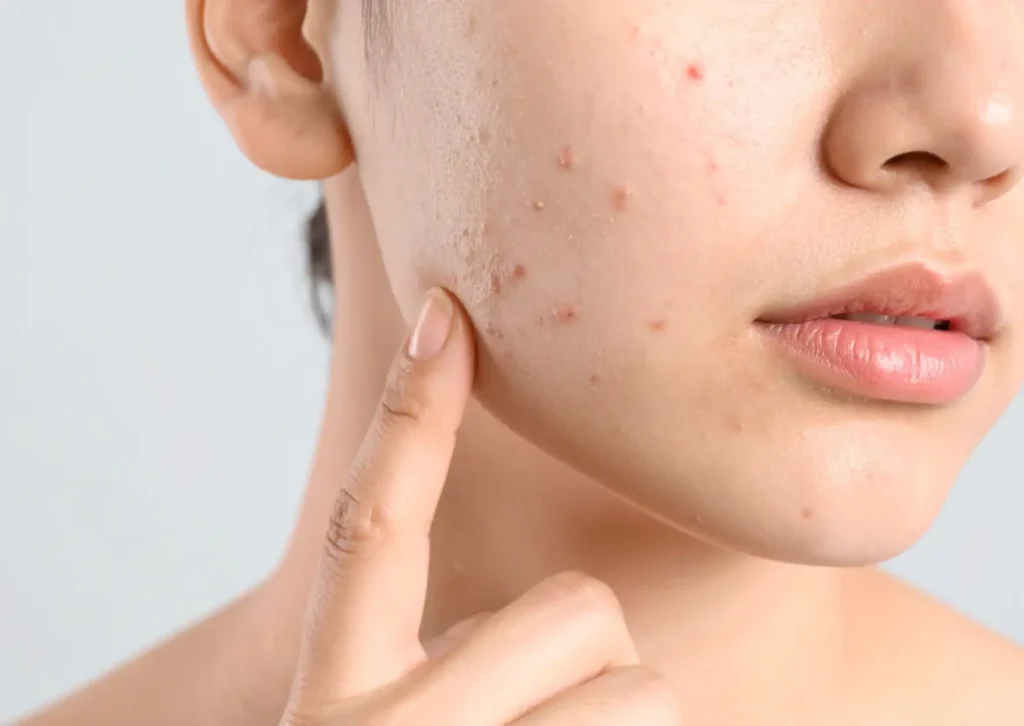 Acne scarring and uneven skin texture that may benefit from advanced laser resurfacing approaches