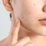 Acne scarring and uneven skin texture that may benefit from advanced laser resurfacing approaches