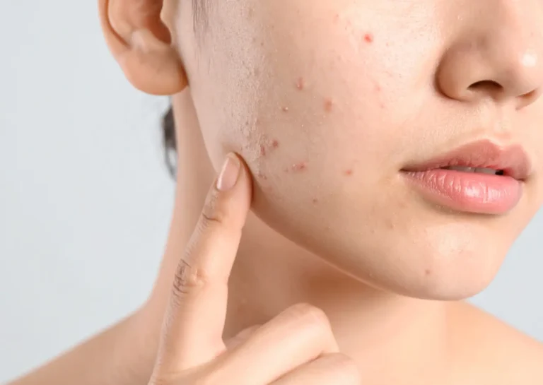 Acne scarring and uneven skin texture that may benefit from advanced laser resurfacing approaches